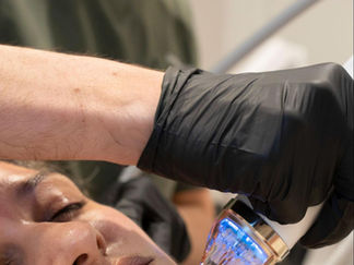 Can You Have Secret RF During Summer A Guide to Safe Summer Skin Rejuvenation
